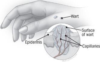 The structure of the wart on his hand