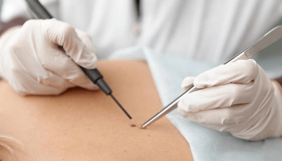 Characteristics of removal of papilloma