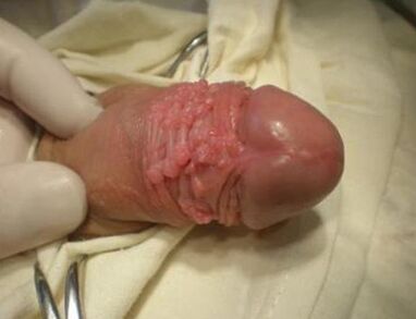Papilloma for a member