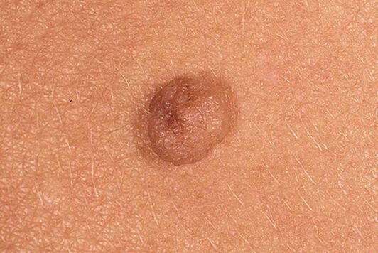 Papilloma