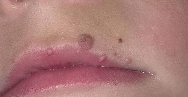 Papillomas on his lips