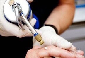 Methods of removing skin papillomas