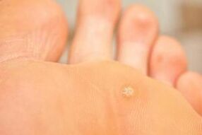 Why plantar warts appear