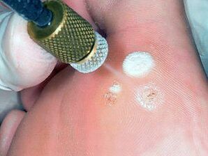 cryodestruction as a method of plantar wart removal