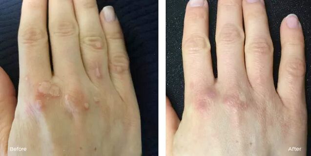 successful removal of warts after using Rimovio gel review by Andrew 2